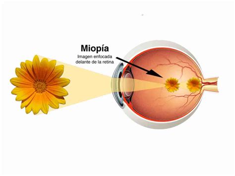 Ametropías En Ojopedia