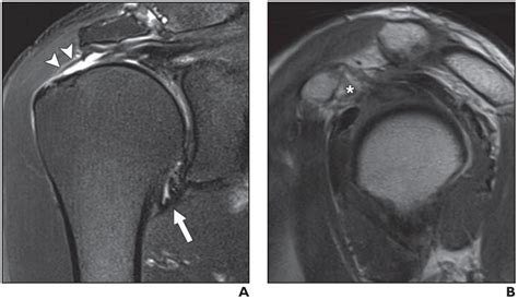 Rotator Cuff Tear MRI Right Shoulder