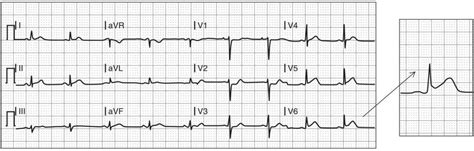 Electrocardiographic Differential Diagnosis of ST Segment Elevation | Anesthesia Key