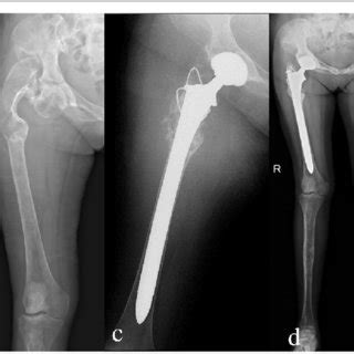 Preoperative Radiography A Bone Scintigraphy B Postoperative