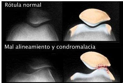 Condromalacia rotuliana causas síntomas y tratamiento Fisiolution