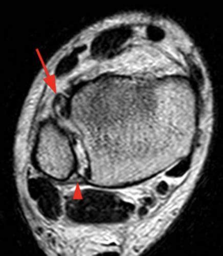 COSM | Ankle diastasis or “High ankle sprain”