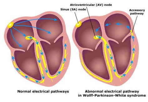 Wolff Parkinson White Wpw Syndrome — Causes Ecg And Treatment