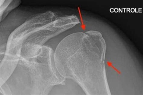 Les fractures de l épaule Clinique de l Epaule et de la Main Paris