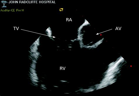 Intracardiac Echocardiography Heart