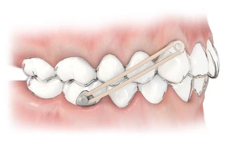 The Inventors Path Orthodontic Products