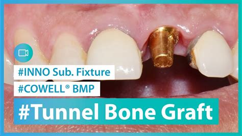 Tunnel Graft Technique Youtube