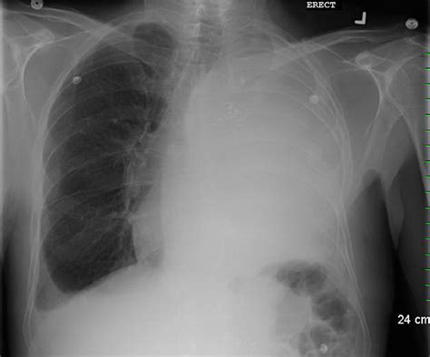 Figure From Heart Failure Due To Tension Hydrothorax After Left