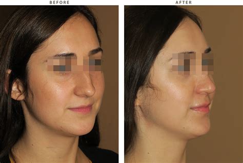 Rhinoplasty – Before and After Pictures * | Dr Turowski - Plastic Surgery Chicago