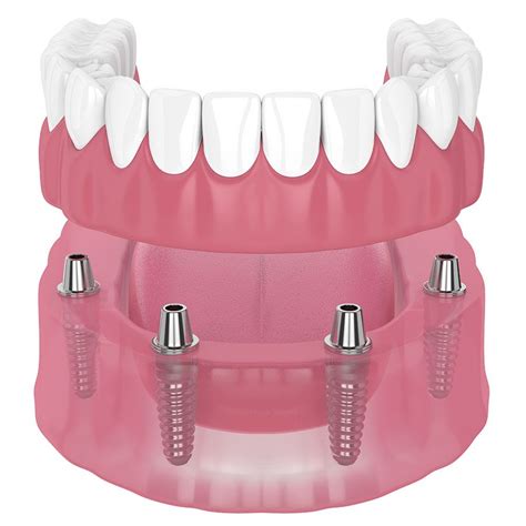 Prótesis dentales sobre implantes Fijas Removibles Híbridas