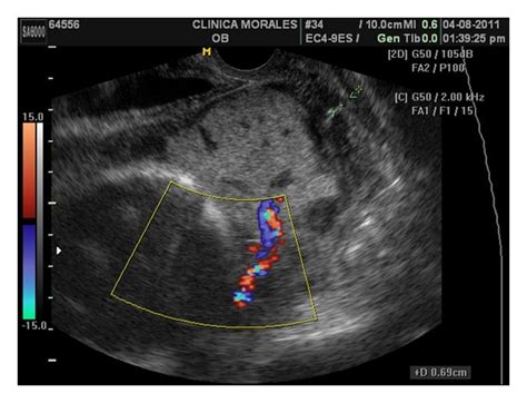 Week 27 Transvaginal Colour Doppler Ultrasound The Aberrant Cotyledon