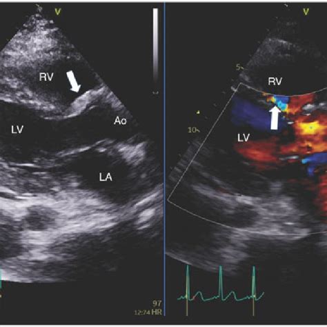 A Postoperative Transthoracic Echocardiography Long Axis Parasternal Download Scientific