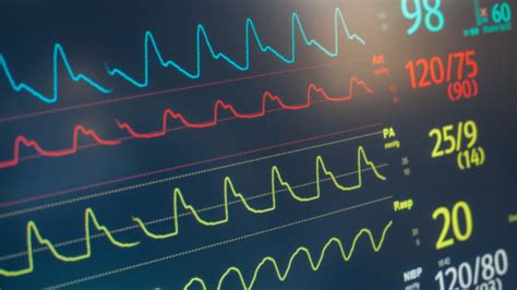 Rhythm Device Therapy For Heart Failure University Hospitals