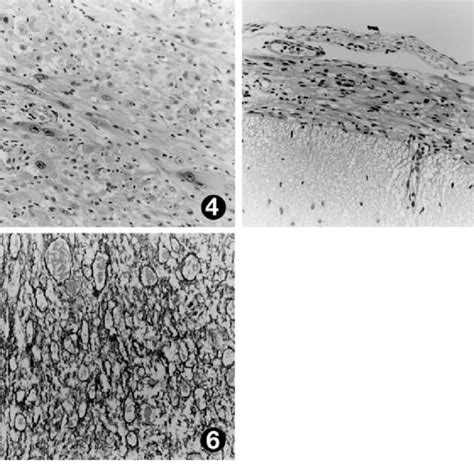 Photomicrograph Demonstrating Pleomorphism And Vacuolated Cytoplasm In