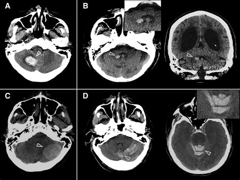 Cerebellar Hematoma Location Stroke