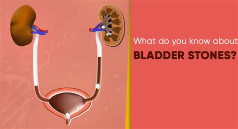 Bladder Stones: Diagnosis and Treatment