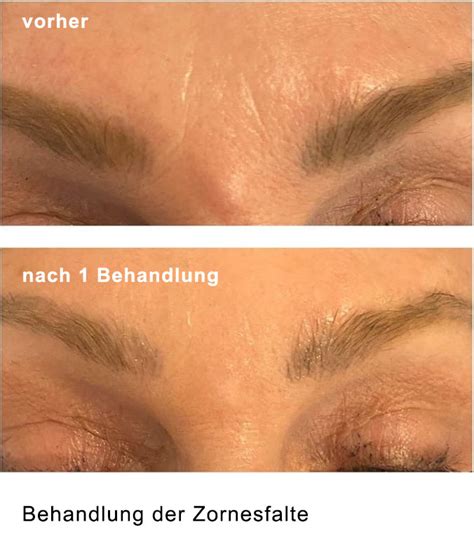 Collagen Fadenlifting Ohne Nadel Gegen Falten Medical Beauty Park