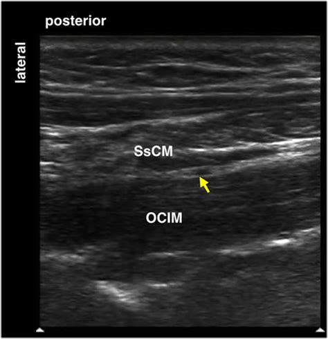 Usra Greater Occipital Nerve Block