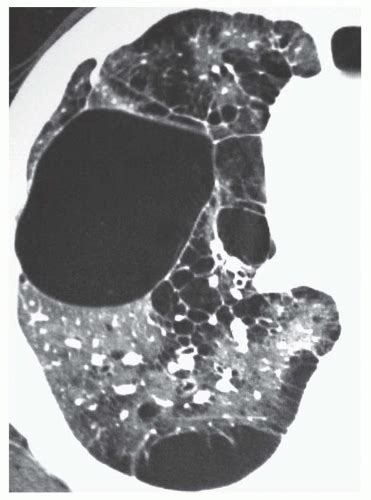 Diffuse Cystic Lung Diseases Radiology Key