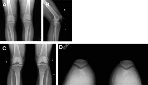 Meniscal Allograft Transplants Musculoskeletal Key