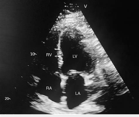 Tte Apical 4 Chamber View Showing Dilated Cardiac Chambers Including