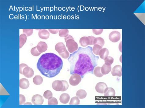 109. Infectious mononucleosis Flashcards | Quizlet 