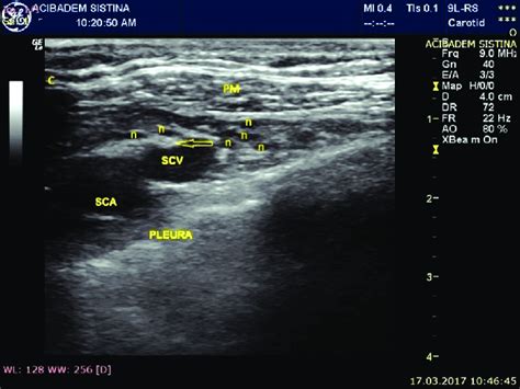 Subclavian Vein Ultrasound