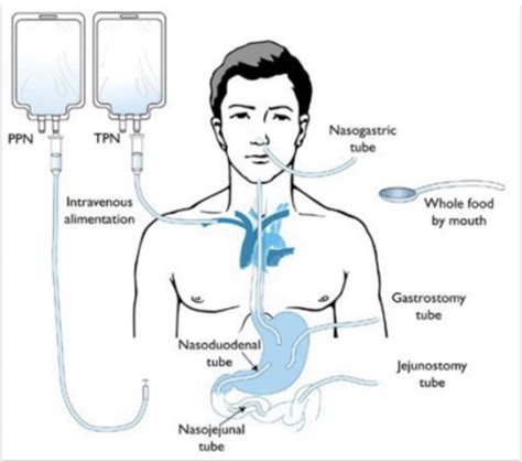 Enteral And Parenteral Nutrition Flashcards Quizlet