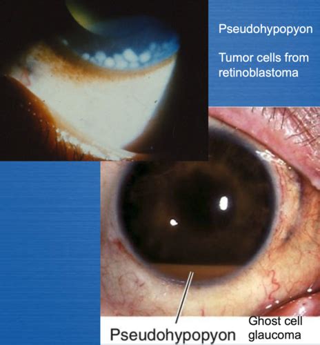 L2 Glaucoma: Anterior Segment Pathophysiology of Glaucoma Flashcards ...