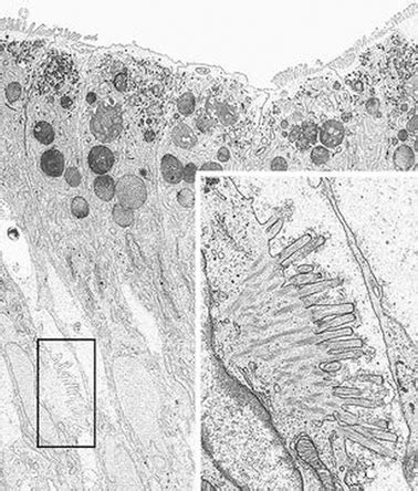 Microvillus Inclusion Disease and Tufting Enteropathy | Abdominal Key