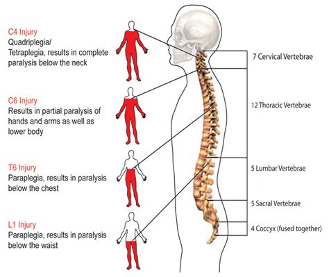 paraplegia injury spinal cord injury nursing spinal cord injury