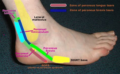 Peroneal Tendon Subluxation & Dislocation - Foot & Ankle - Orthobullets