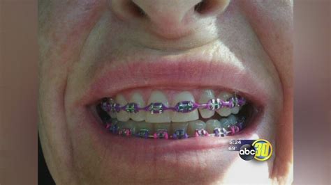 Never Too Old for Braces - ABC30 Fresno