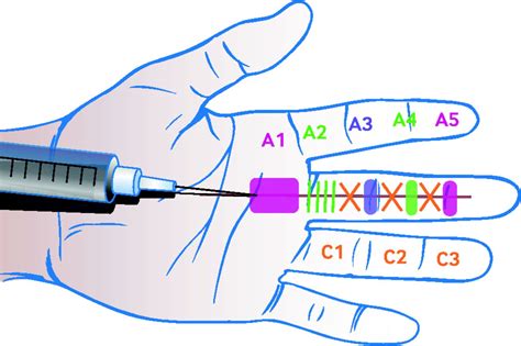 Acquired Triggering Of The Fingers And Thumb In Adults The Bmj