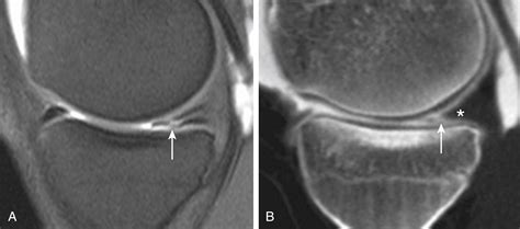 Computed Tomography Of The Knee Joint Indications And Significance