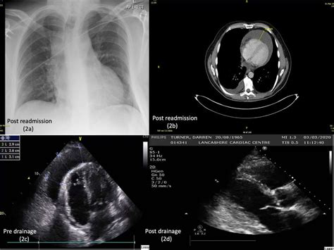 A Cxr Post Readmission By Pericardial Effusion B Ct Post