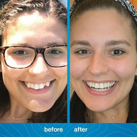 Invisalign In Palos Verdes And South Bay California