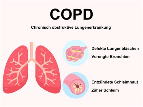 Copd Schwabe Austria