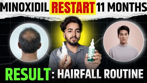 Minoxidil Restart Month Hair Growth Results Sahil Nagpal Youtube