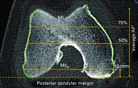 Morphometric Analysis Of The Distal Femur In Total Knee Arthroplasty