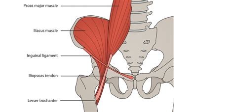 Iliopsoas Tendonitis Symptoms Causes Treatment Preventions & More All ...