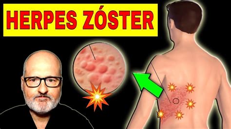 HERPES ZÓSTER Culebrilla Causas Síntomas y Soluciones YouTube