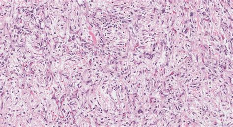 Dedifferentiated Liposarcoma Ottawa Atlas Of Pathology