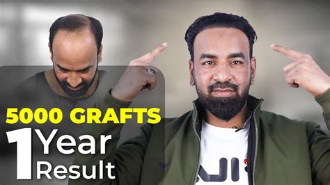 From Baldness To Confidence 5000 Grafts Hair Transplant Journey 1