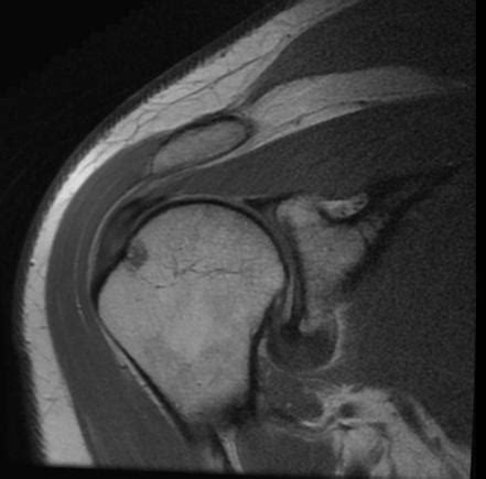 Adhesive Capsulitis Of The Shoulder Radiology Reference Article