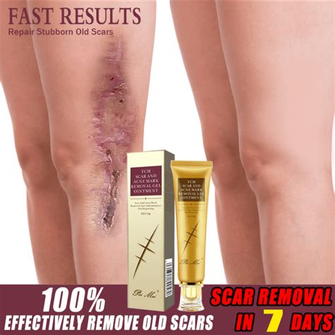 Scar Remover For Old Scar On Leg Bio Oil Stretch Peklat Scars Remover