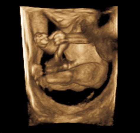 Prenatal Sonographic Detection Of Skeletal Dysplasias A Case Of