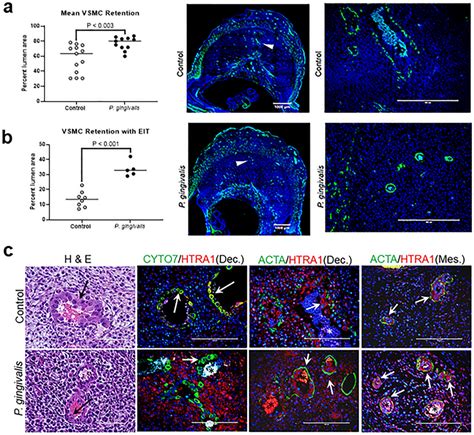 Retention Of Spiral Arterial Vsmc And Invasive Endovascular