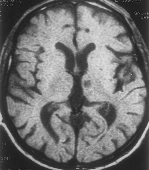 Thalamic Vascular Lesions Stroke