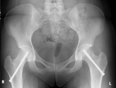 Slipped Capital Femoral Epiphysis (SCFE) - John C. Clohisy, MD